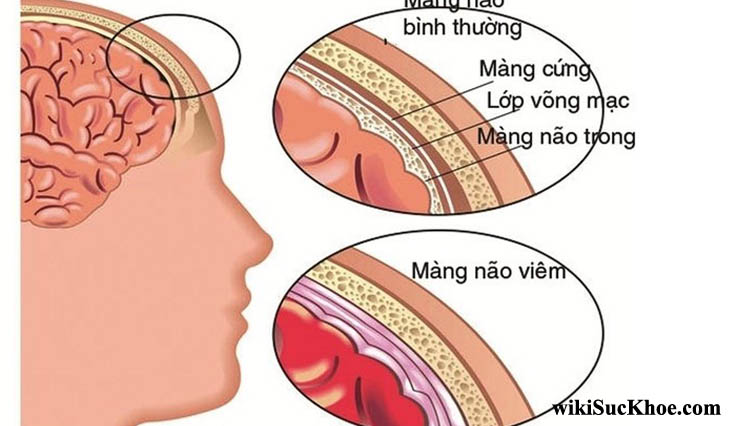 Bệnh viêm màng não do tụ cầu